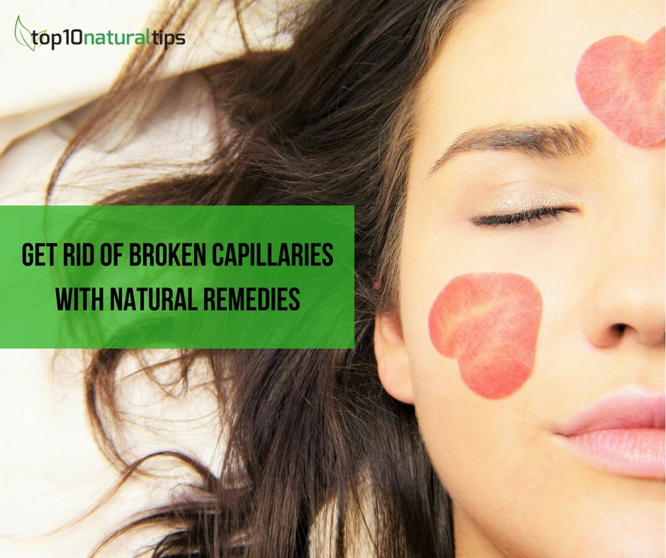 broken capillaries home treatment