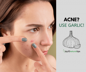 garlic for acne scars